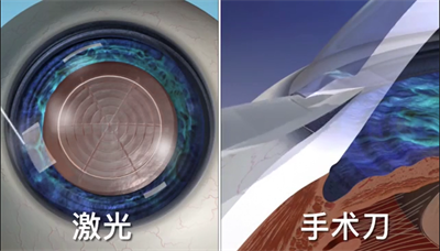 白內(nèi)障手術